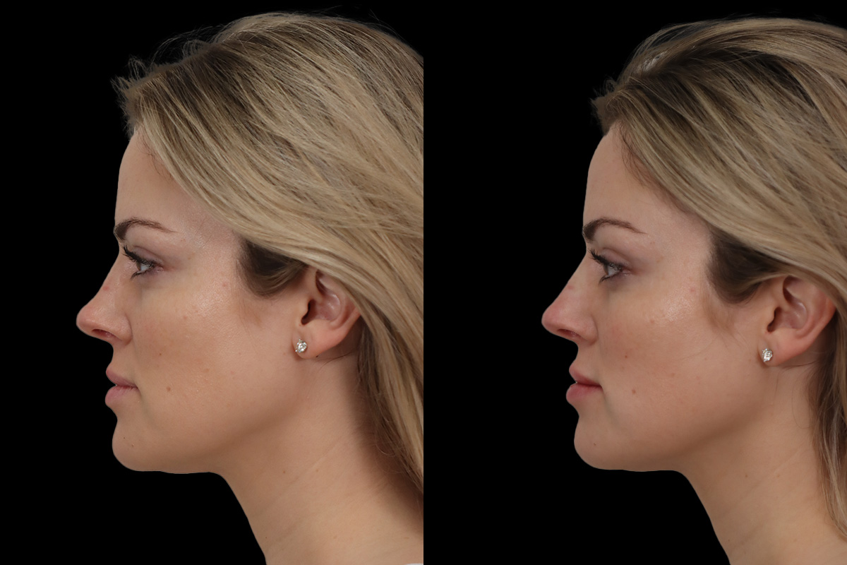 Nose Before & After Gallery - Patient 244578 - Image 3