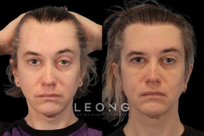 Hair Restoration Before & After Gallery - Patient 178570 - Image 1