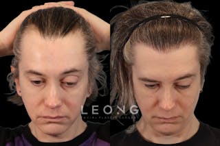Hair Restoration Before & After Gallery - Patient 178570 - Image 2