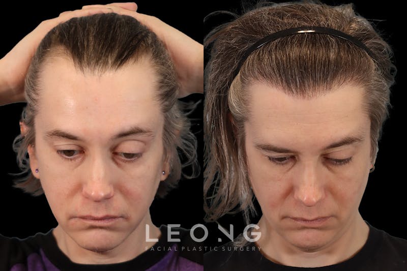 Hair Restoration Before & After Gallery - Patient 178570 - Image 2
