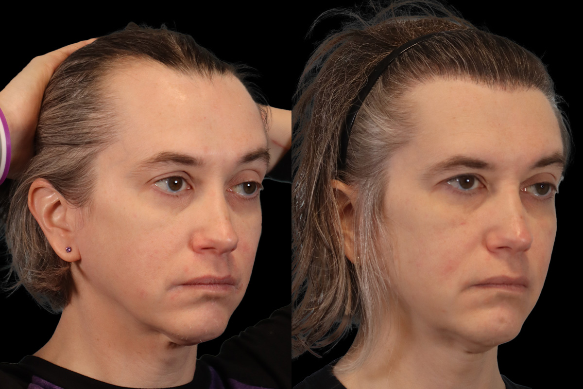 Hair Restoration Before & After Gallery - Patient 178570 - Image 3