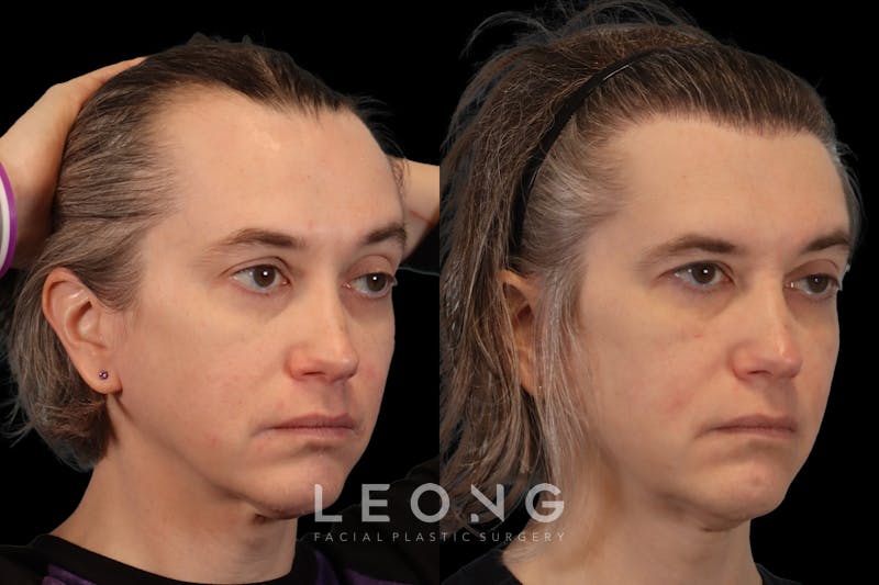 Hair Restoration Before & After Gallery - Patient 178570 - Image 3