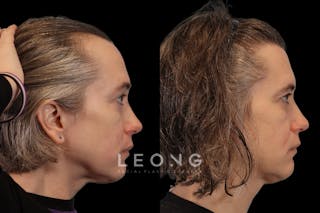 Hair Restoration Before & After Gallery - Patient 178570 - Image 4