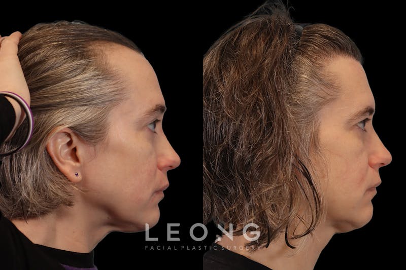 Hair Restoration Before & After Gallery - Patient 178570 - Image 4