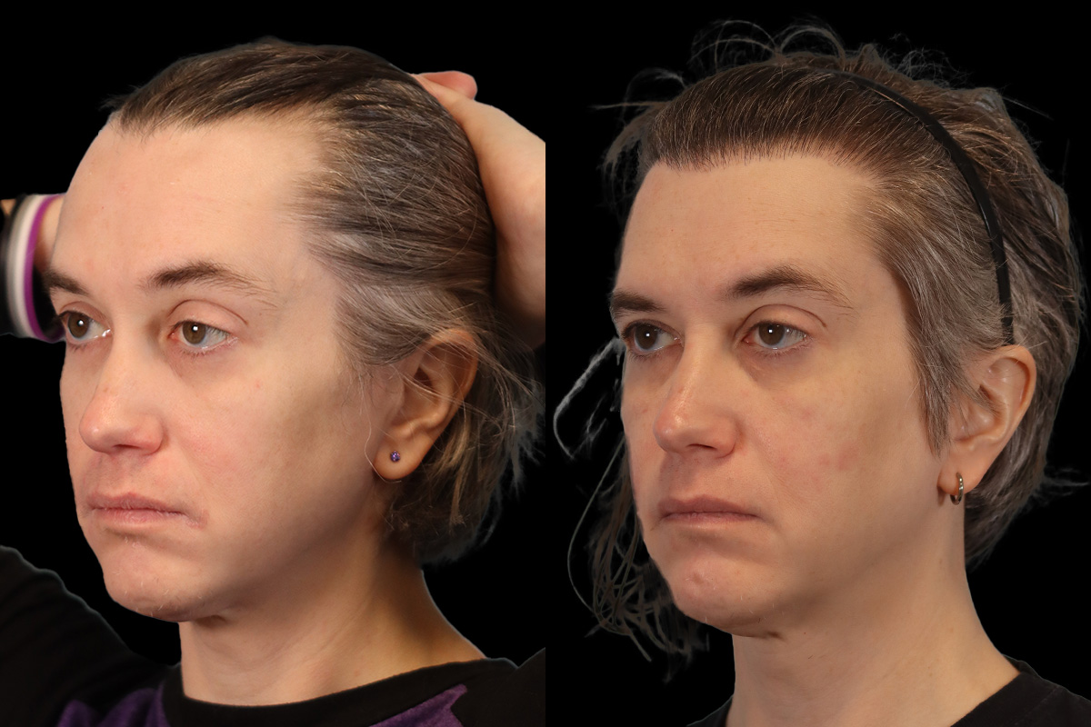 Hair Restoration Before & After Gallery - Patient 178570 - Image 5