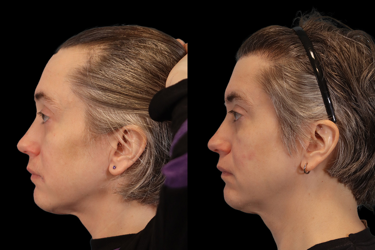 Hair Restoration Before & After Gallery - Patient 178570 - Image 6