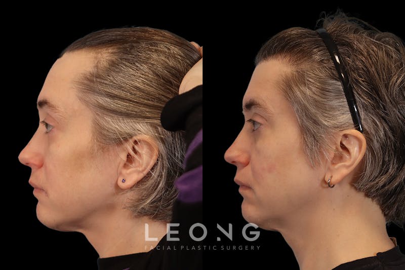 Hair Restoration Before & After Gallery - Patient 178570 - Image 6