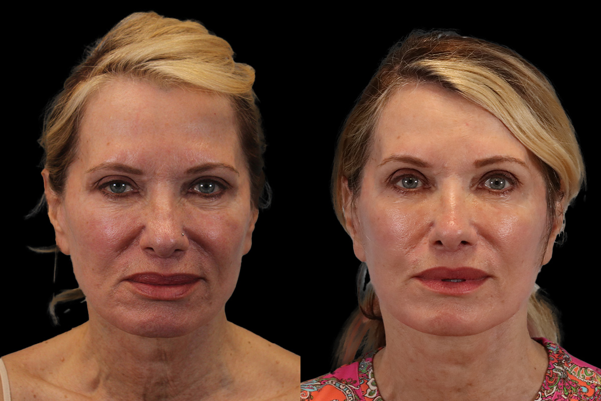 Facelift Before & After Gallery - Patient 311025 - Image 1