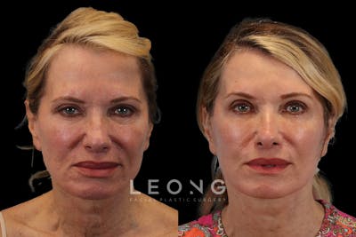 Facelift Before & After Gallery - Patient 311025 - Image 1