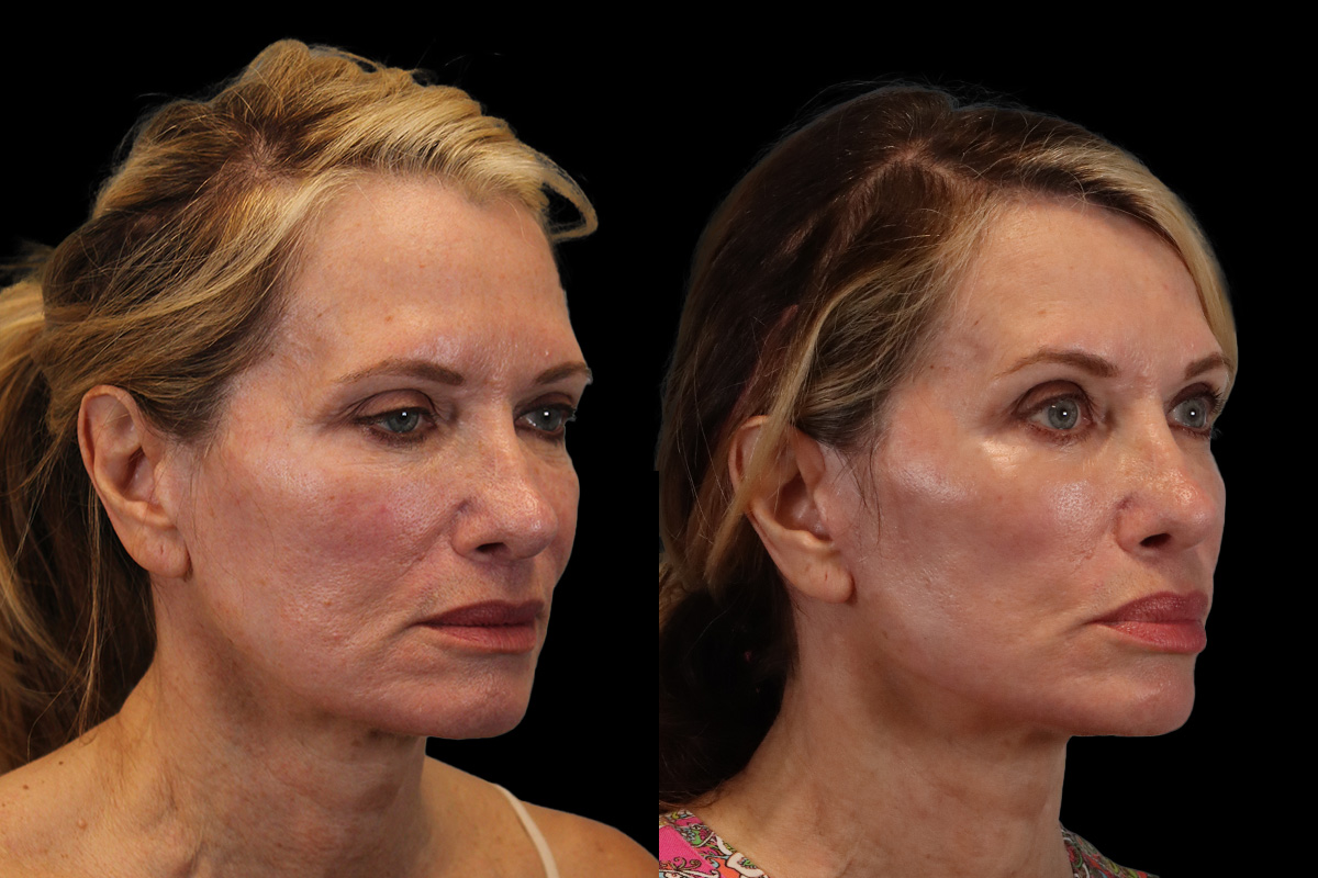 Facelift Before & After Gallery - Patient 311025 - Image 2