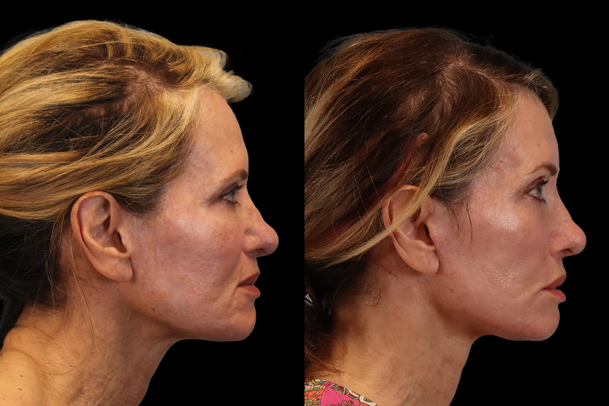 Facelift Before & After Gallery - Patient 311025 - Image 3