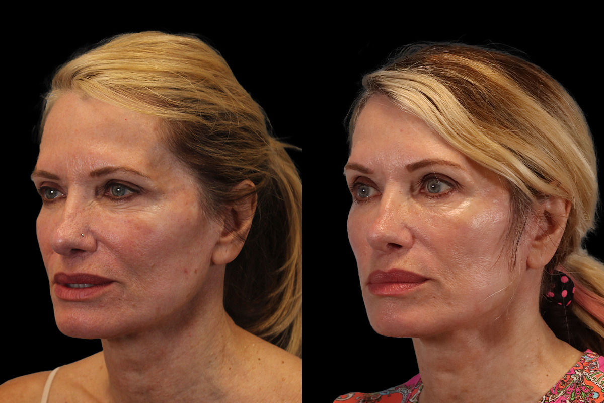 Facelift Before & After Gallery - Patient 311025 - Image 4