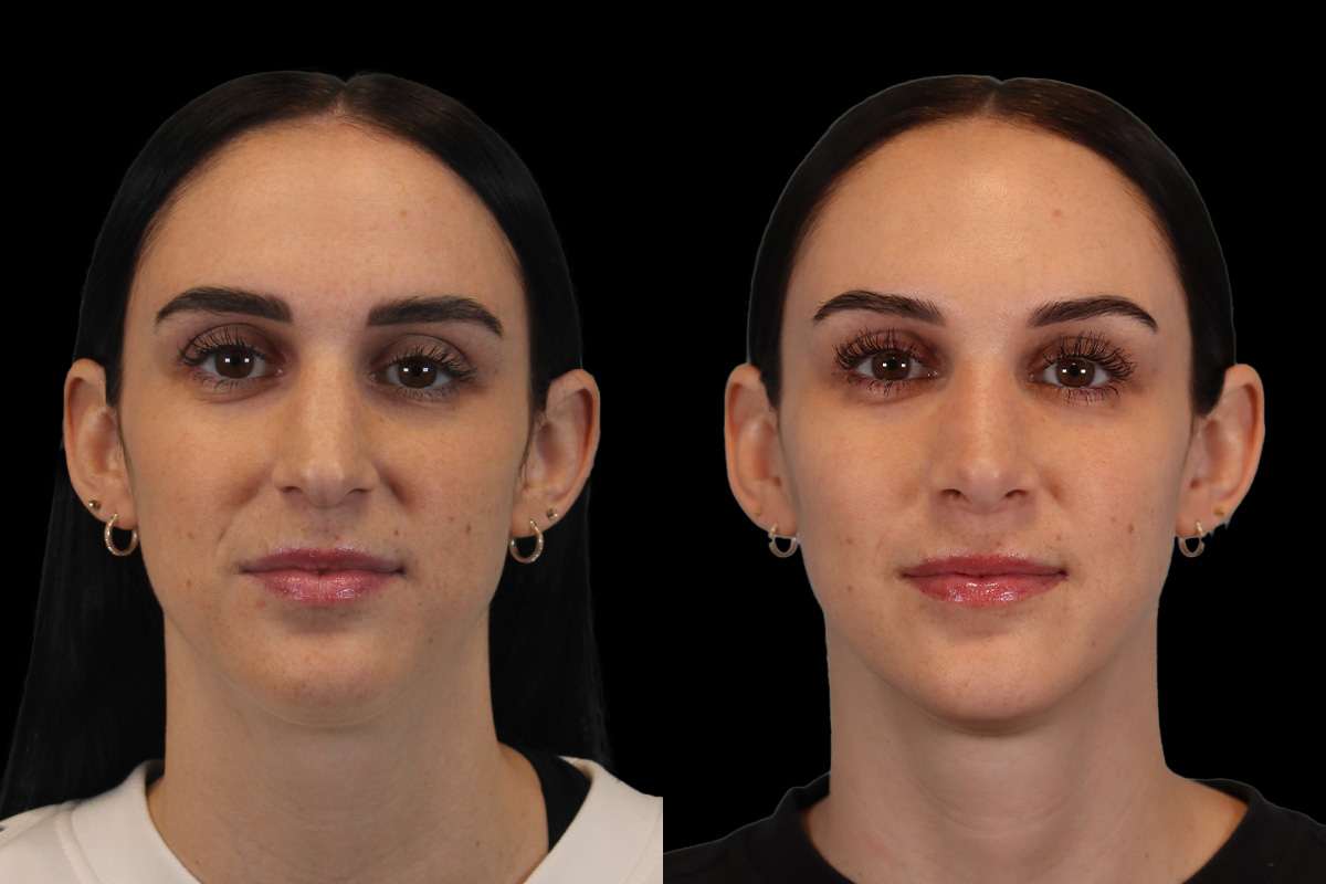 Rhinoplasty Before & After Gallery - Patient 234509 - Image 1