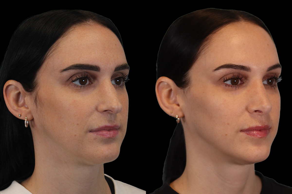 Rhinoplasty Before & After Gallery - Patient 234509 - Image 3