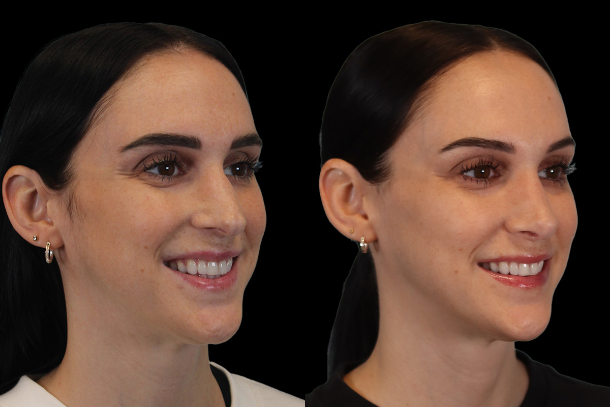 Rhinoplasty Before & After Gallery - Patient 234509 - Image 4