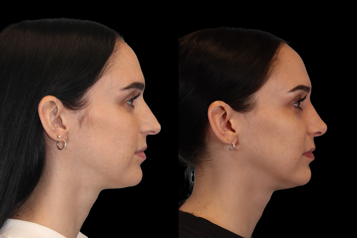 Rhinoplasty Before & After Gallery - Patient 234509 - Image 5