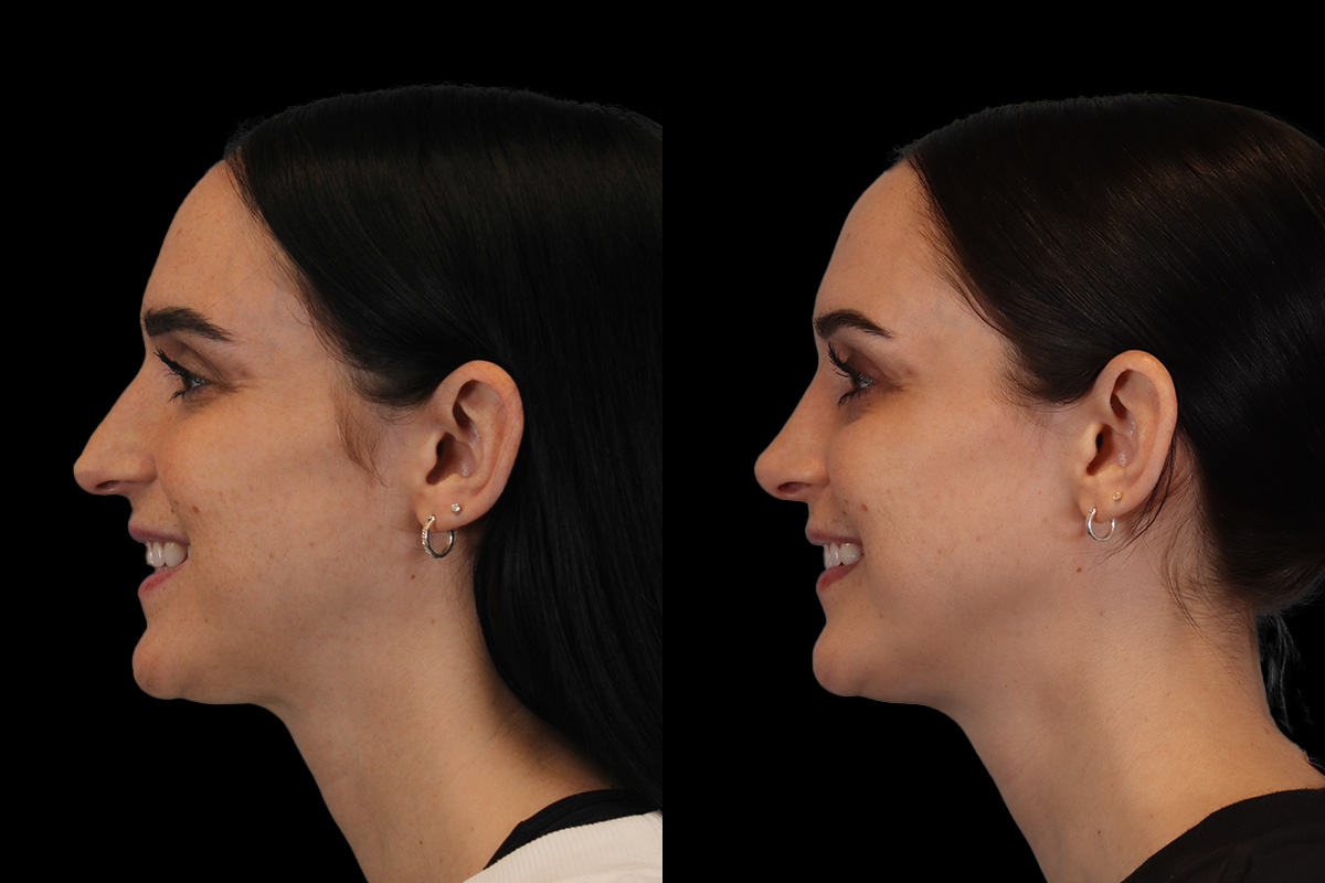 Rhinoplasty Before & After Gallery - Patient 234509 - Image 9