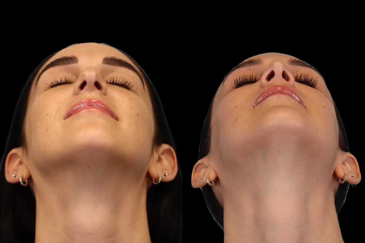 Rhinoplasty Before & After Gallery - Patient 234509 - Image 10