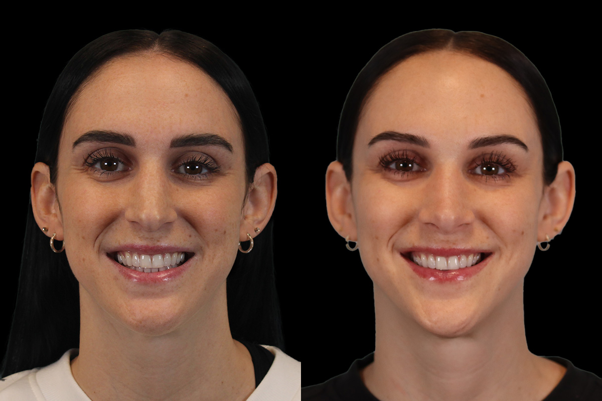 Rhinoplasty Before & After Gallery - Patient 234509 - Image 2