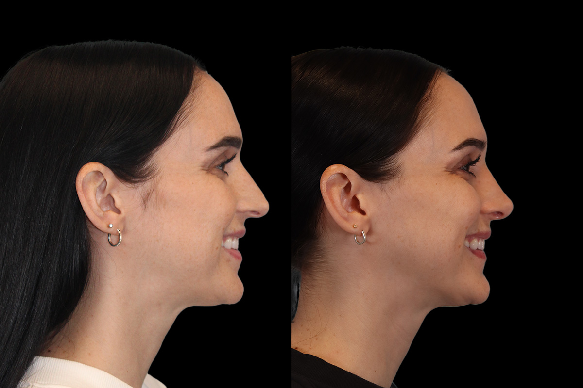 Rhinoplasty Before & After Gallery - Patient 234509 - Image 6
