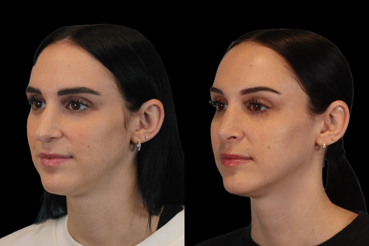 Rhinoplasty Before & After Gallery - Patient 234509 - Image 7