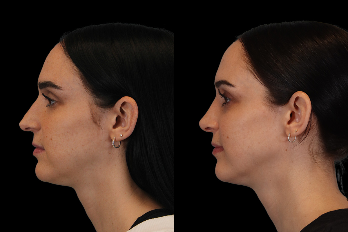 Rhinoplasty Before & After Gallery - Patient 234509 - Image 8