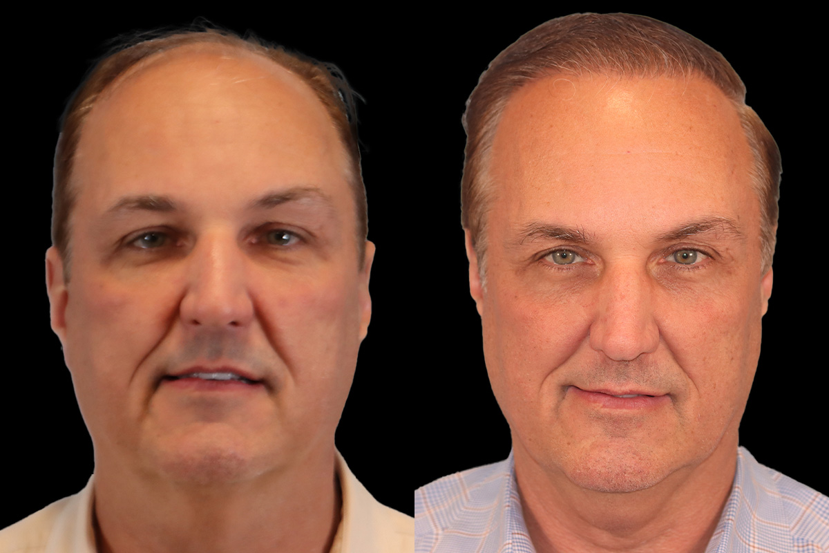 Hair Transplant Before & After Gallery - Patient 340739 - Image 1