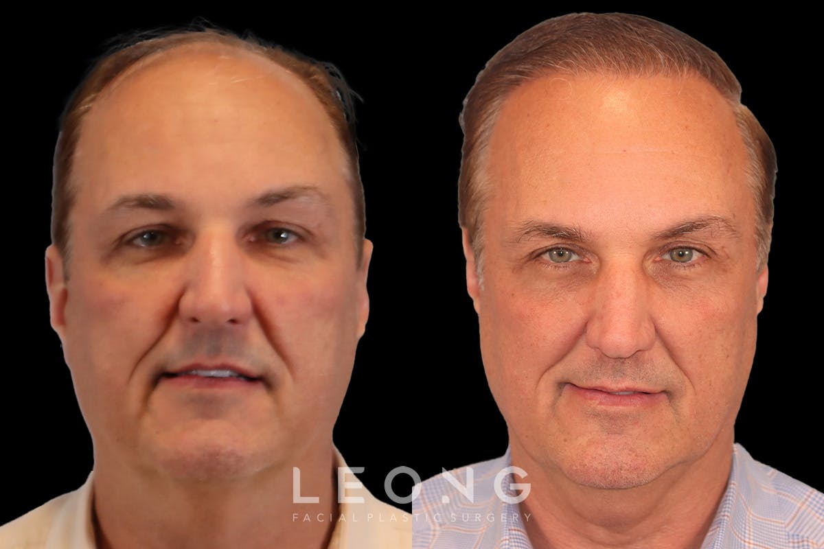 Hair Transplant Before & After Gallery - Patient 340739 - Image 1
