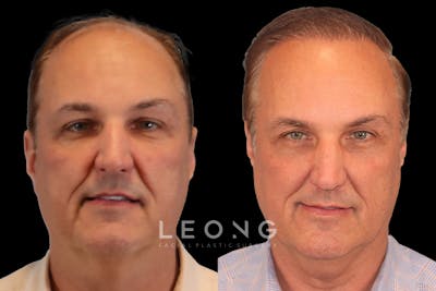 Hair Restoration Before & After Gallery - Patient 213510 - Image 1