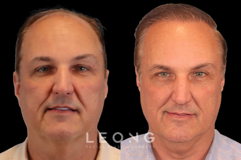 Hair Restoration Before & After Gallery - Patient 213510 - Image 1