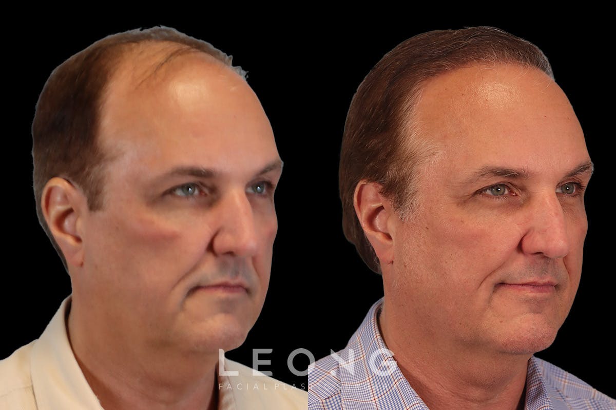 Hair Transplant Before & After Gallery - Patient 340739 - Image 2