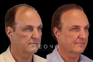Hair Restoration Before & After Gallery - Patient 213510 - Image 2