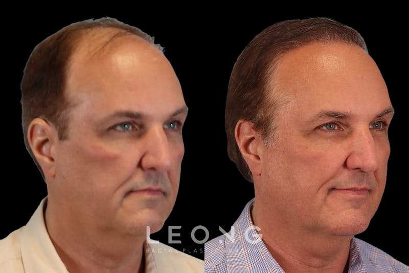 Hair Restoration Before & After Gallery - Patient 213510 - Image 2