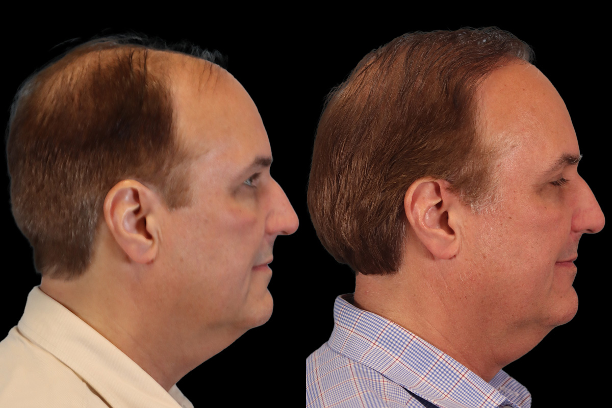 Hair Transplant Before & After Gallery - Patient 340739 - Image 3