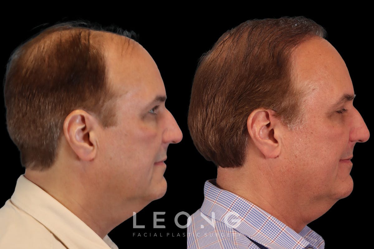 Hair Transplant Before & After Gallery - Patient 340739 - Image 3