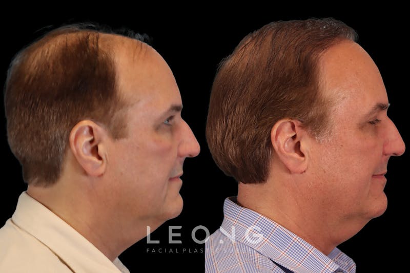 Hair Restoration Before & After Gallery - Patient 213510 - Image 3