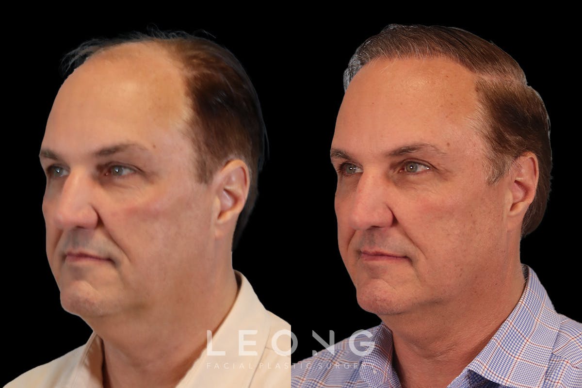 Hair Transplant Before & After Gallery - Patient 340739 - Image 4