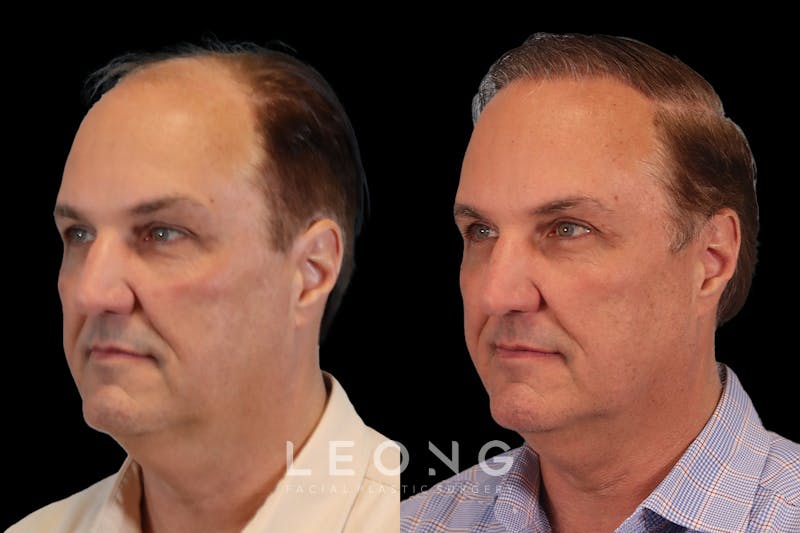 Hair Restoration Before & After Gallery - Patient 213510 - Image 4