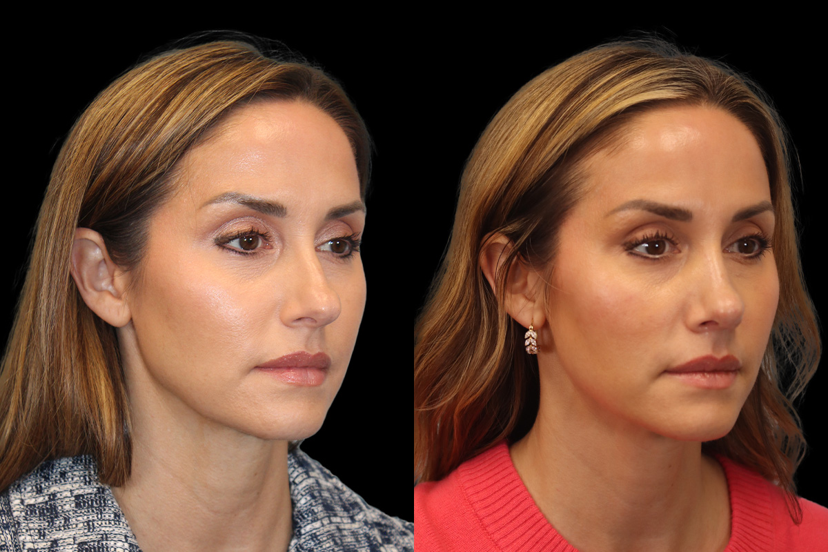 Rhinoplasty Before & After Gallery - Patient 178382 - Image 2