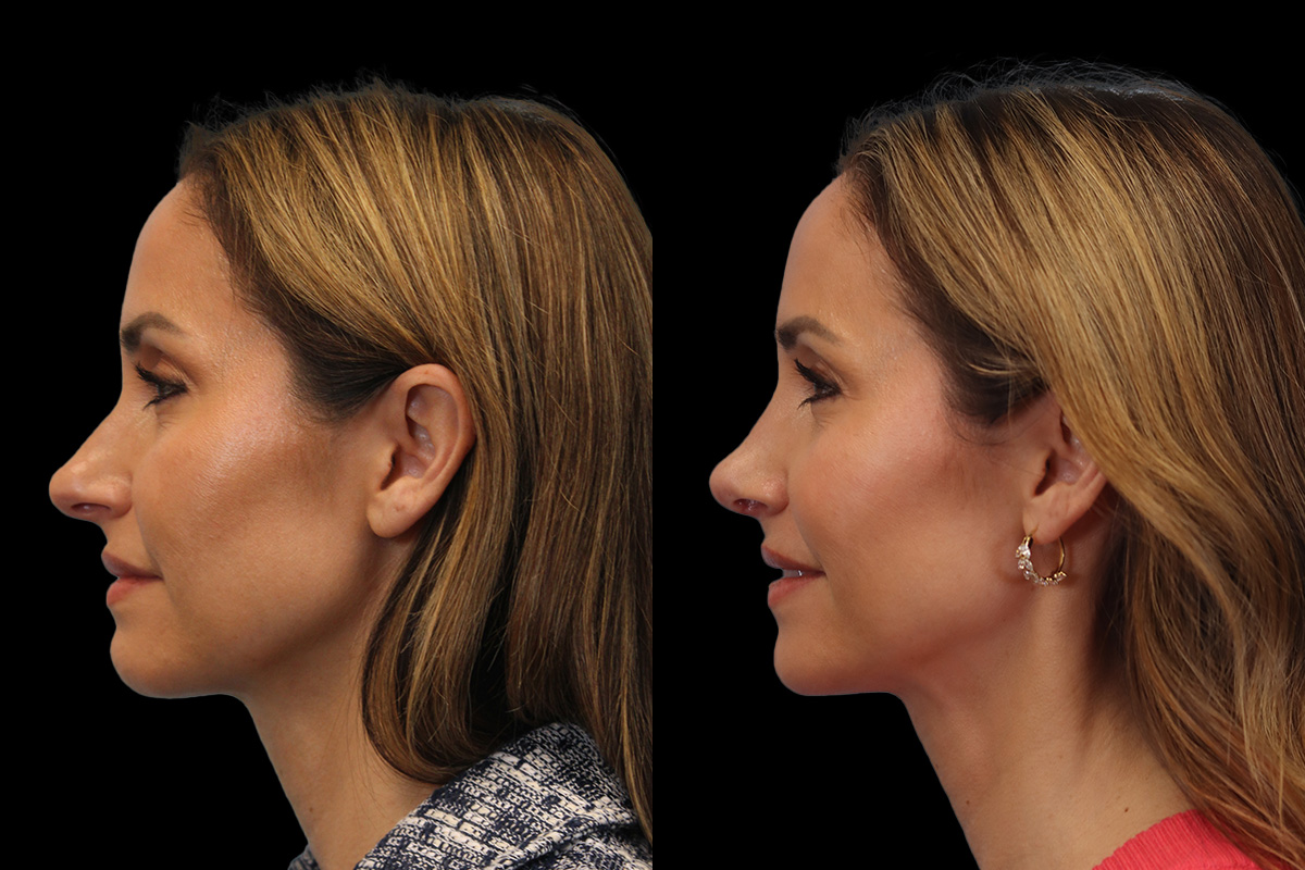 Rhinoplasty Before & After Gallery - Patient 178382 - Image 6