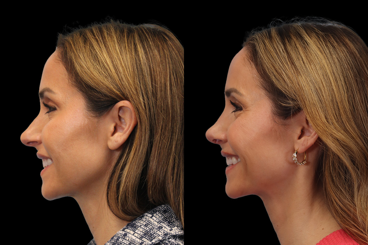 Rhinoplasty Before & After Gallery - Patient 178382 - Image 7
