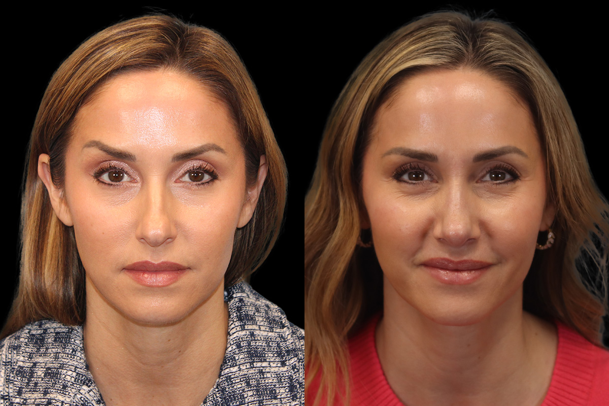 Rhinoplasty Before & After Gallery - Patient 178382 - Image 1