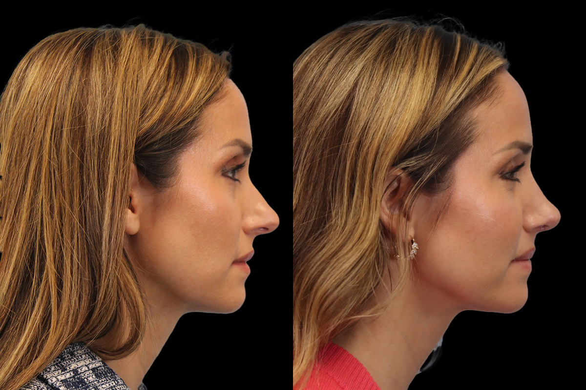 Rhinoplasty Before & After Gallery - Patient 178382 - Image 3