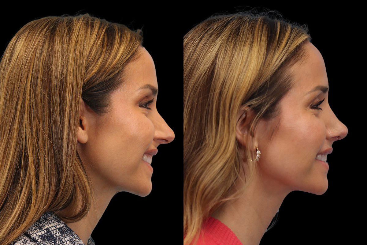 Rhinoplasty Before & After Gallery - Patient 178382 - Image 4