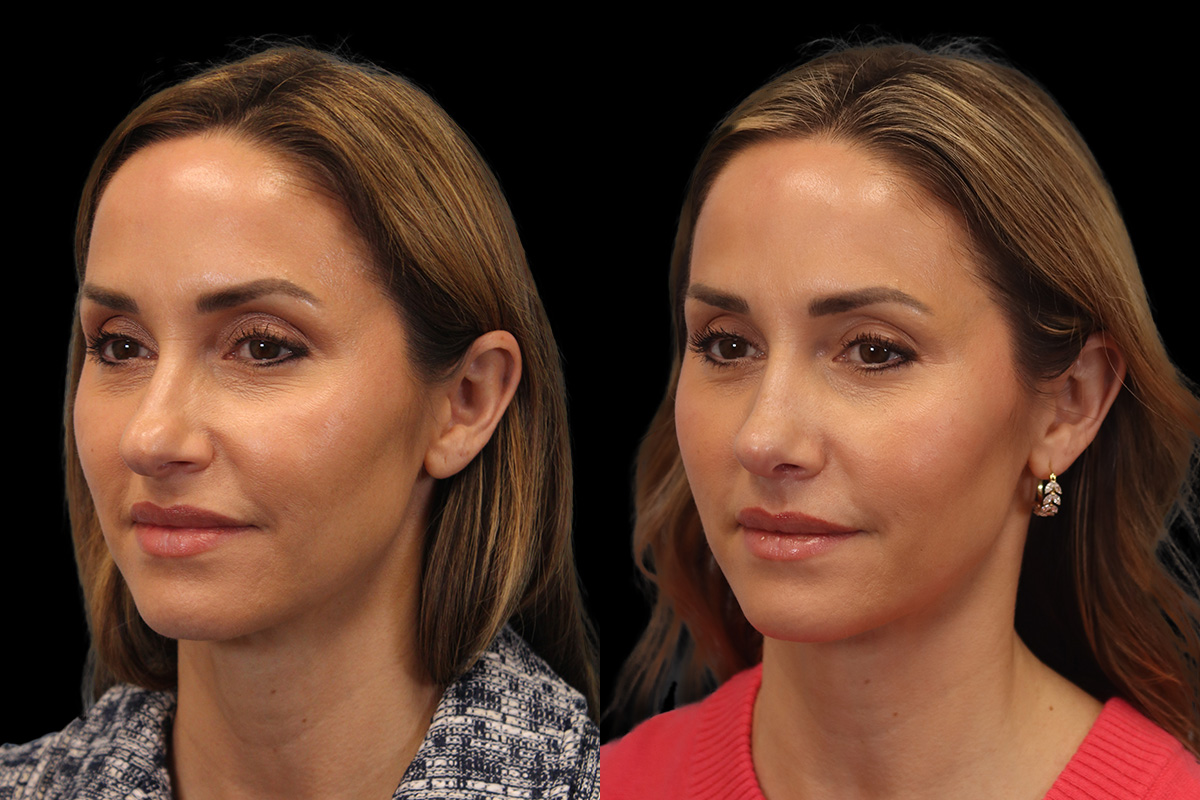 Rhinoplasty Before & After Gallery - Patient 178382 - Image 5