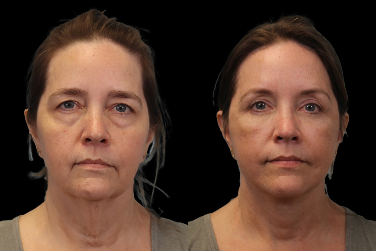 Facelift Before & After Gallery - Patient 102540 - Image 1