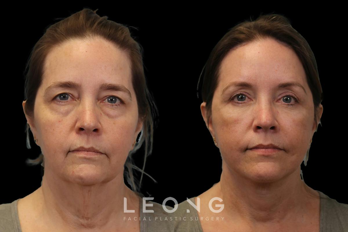 Facelift Before & After Gallery - Patient 102540 - Image 1