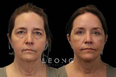 Facelift Before & After Gallery - Patient 102540 - Image 1