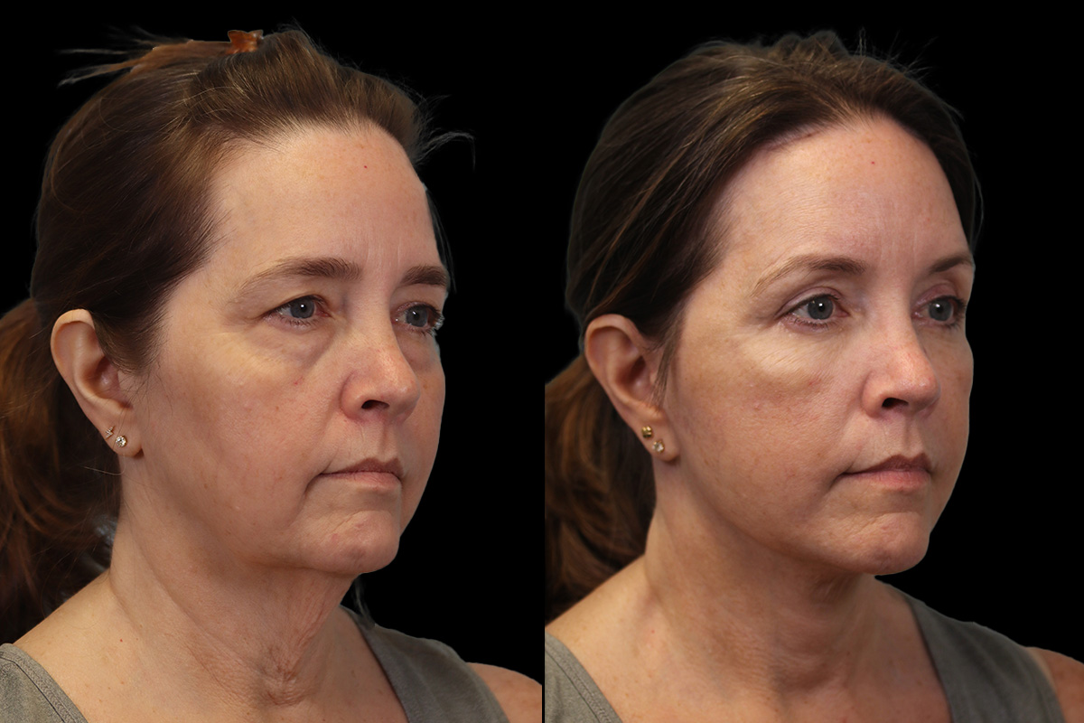 Facelift Before & After Gallery - Patient 102540 - Image 2