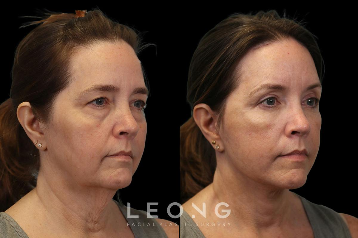 Facelift Before & After Gallery - Patient 102540 - Image 2